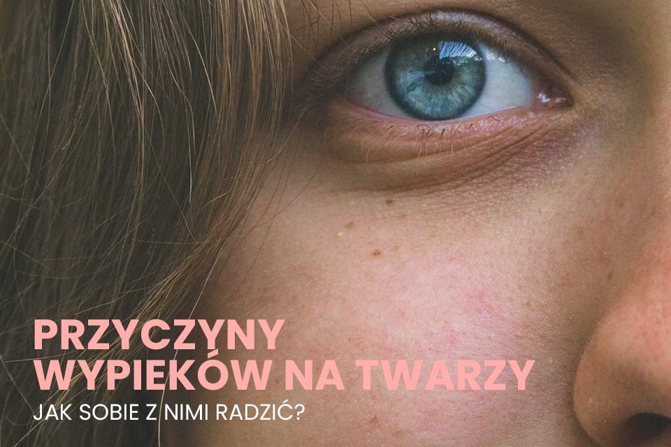 przyczyny wypieków na twarzy